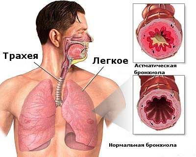 Классификация и причины возникновения астмы